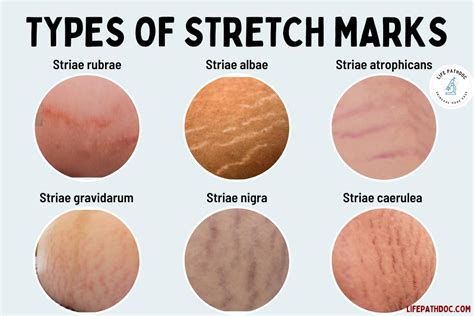 Do You Get Stretch Marks from Working Out? And Can They Be a Sign of Progress?